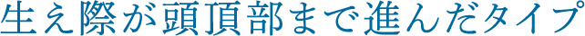 生え際が頭頂部まで進んだタイプ