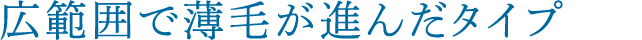 広範囲で薄毛が進んだタイプ